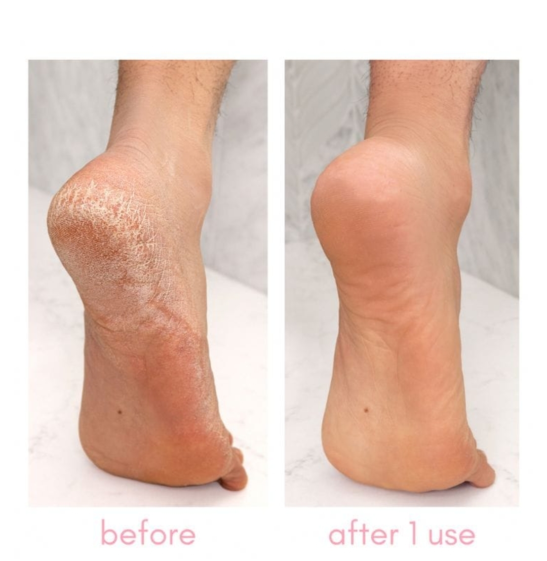 How to use the Electric Callus Remover