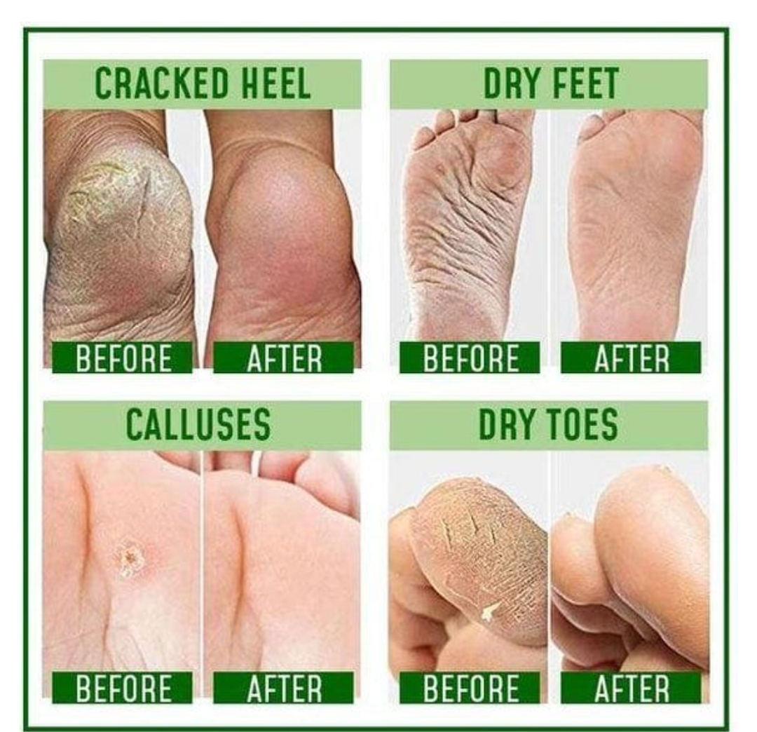 Electric Callus Remover device